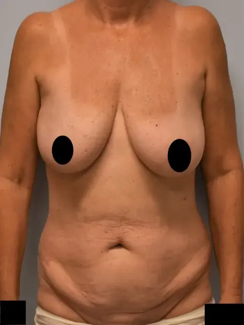 Mommy Makeover patient 3, before