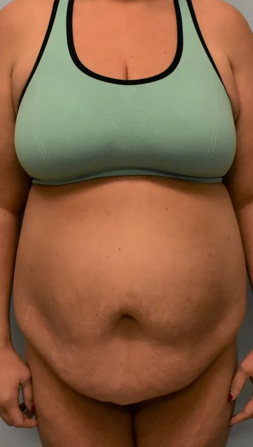 Tummy Tuck patient 1, before