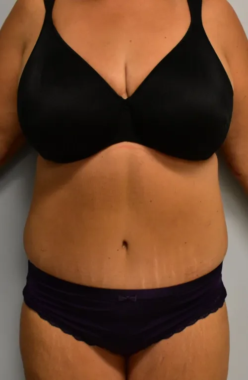 Tummy Tuck patient 1, after