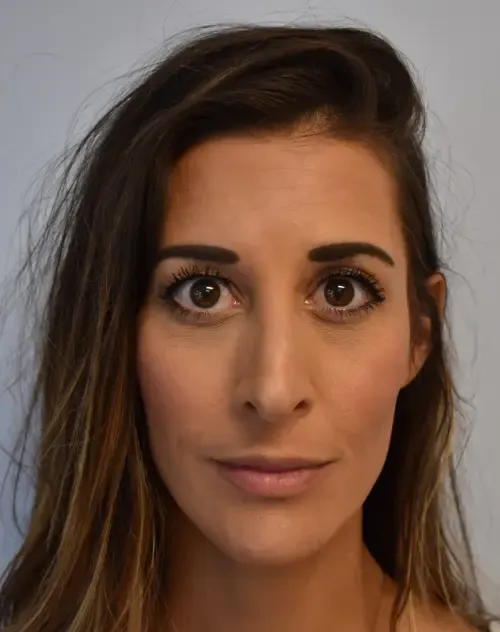 Rhinoplasty patient 4, before