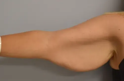 Arm Lift patient 1, before