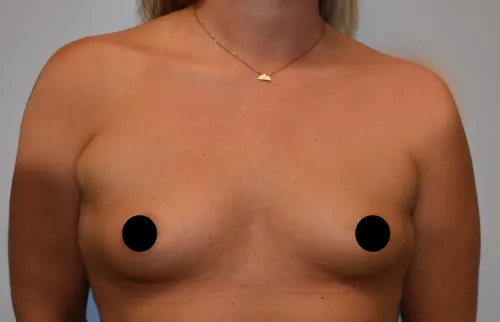 Breast Augmentation patient 6, before