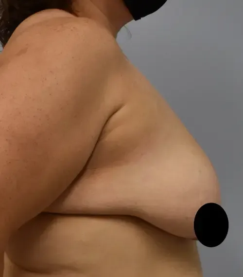 Breast Lift patient 14, before