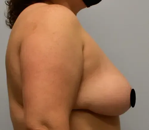 Breast Lift patient 14, after