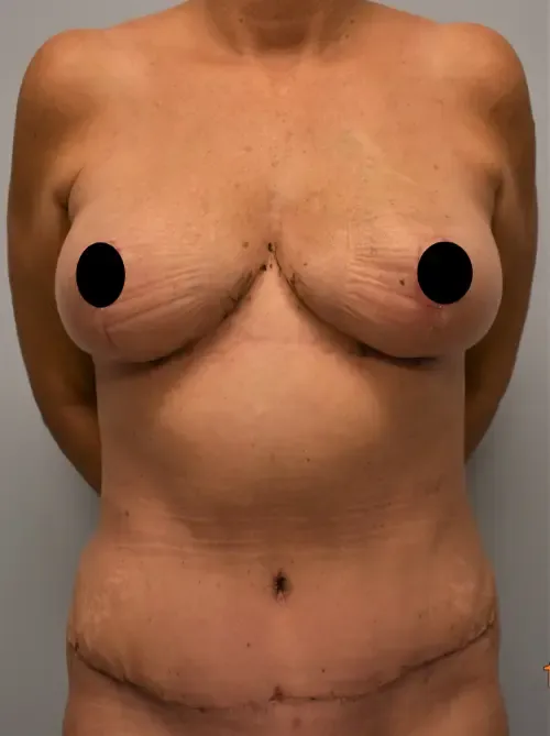 Mommy Makeover patient 3, after