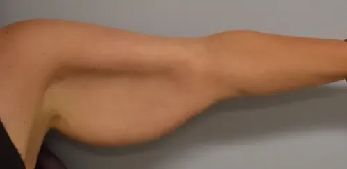 Arm Lift patient 2, before