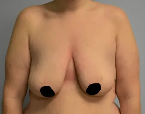 Breast Lift patient 5, before