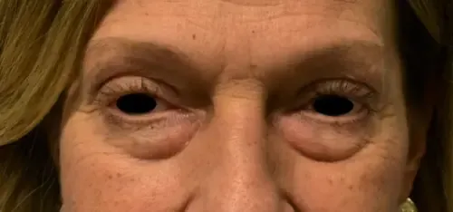 Eyelid Lift (Blepharoplasty) patient 3, before
