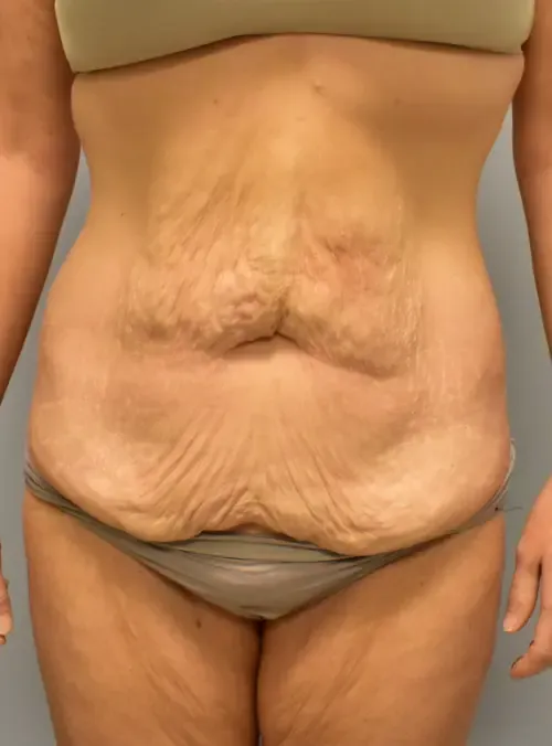 Tummy Tuck patient 1, before