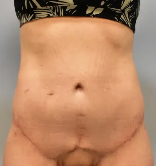 Tummy Tuck patient 6, after