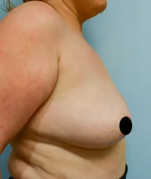 Breast Lift patient 10, after