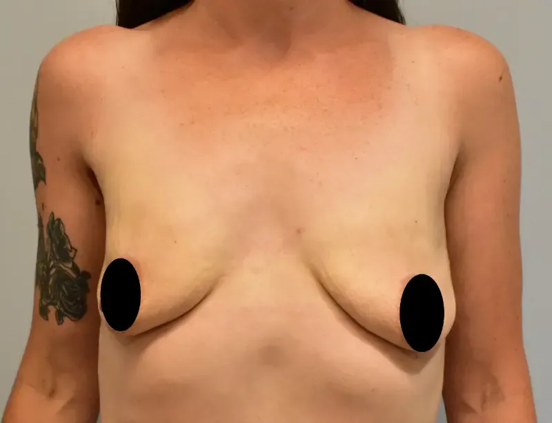 Breast Augmentation patient 2, before