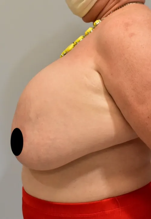 Breast Lift patient 3, before