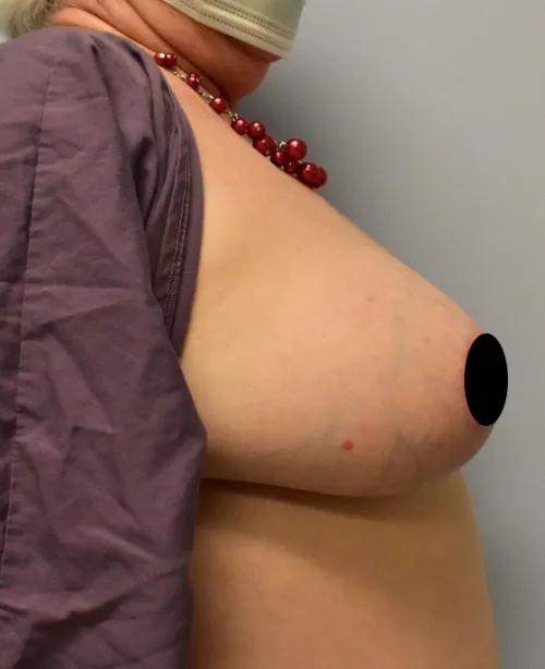 Breast Lift patient 2, after