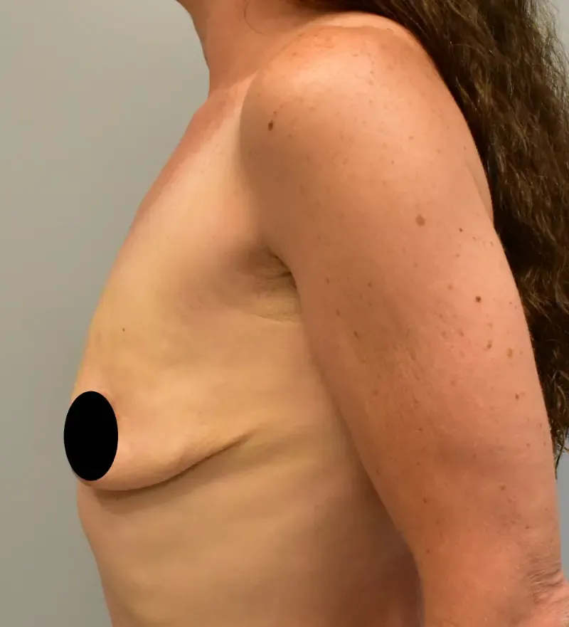 Breast Augmentation patient 3, before