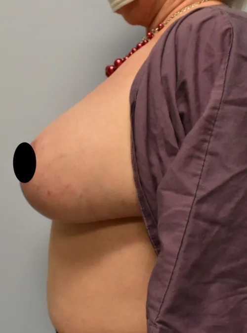 Breast Lift patient 3, after