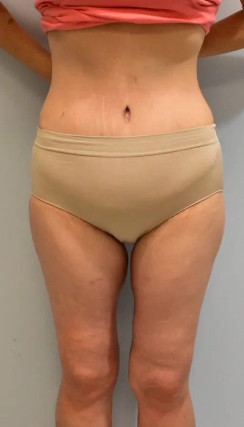 Tummy Tuck patient 3, after