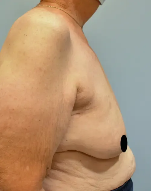 Breast Lift patient 7, before