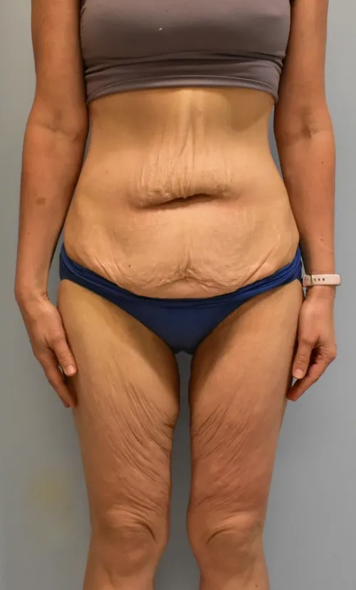 Tummy Tuck patient 3, before