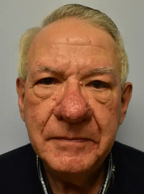 Rhinoplasty patient 3, before