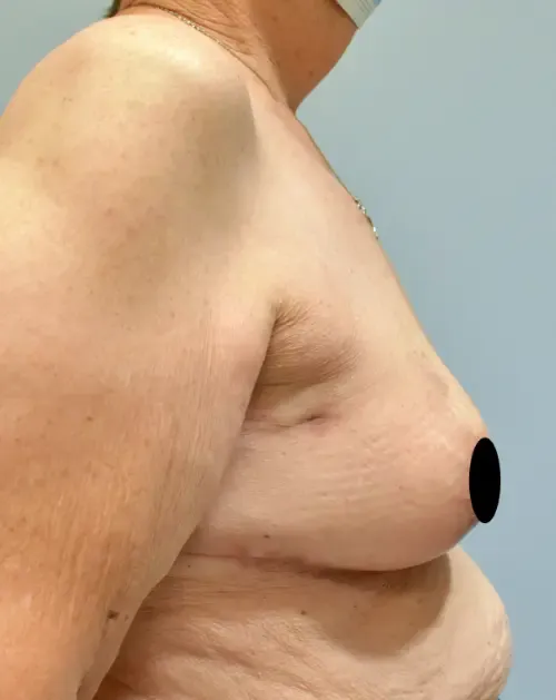 Breast Lift patient 7, after