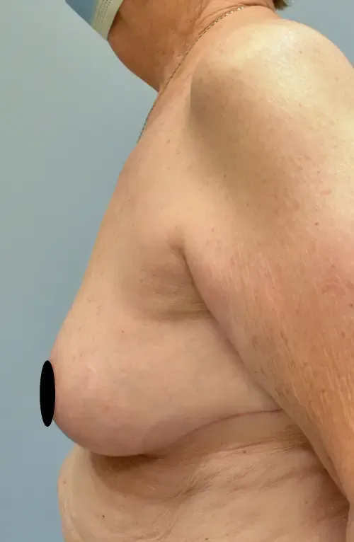 Breast Lift patient 8, after