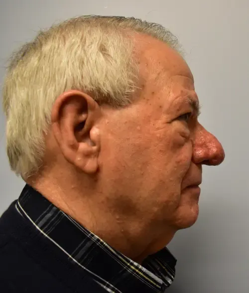Rhinoplasty patient 3, before