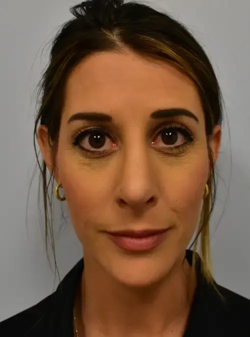 Rhinoplasty patient 4, after