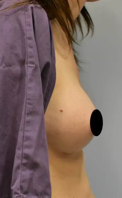 Breast Augmentation patient 5, after