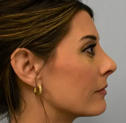 Rhinoplasty patient 6, after
