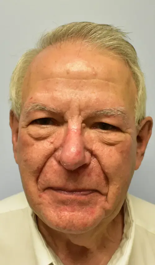 Rhinoplasty patient 3, after