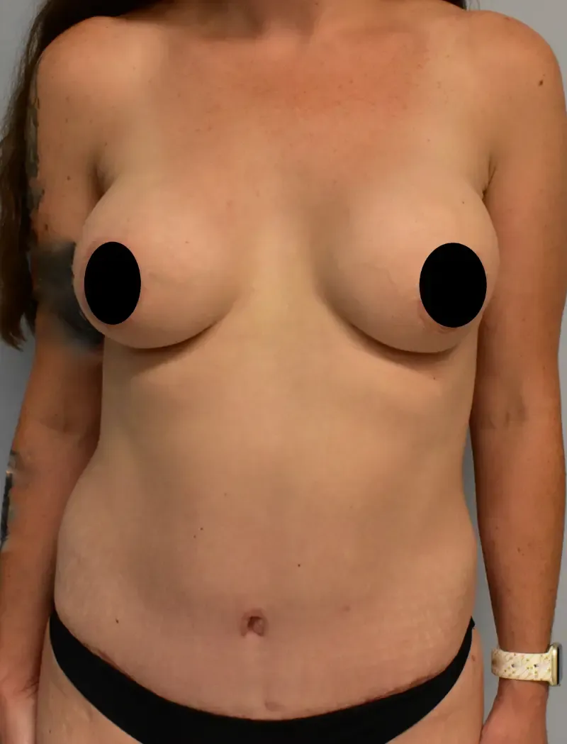 Breast Augmentation patient 2, after
