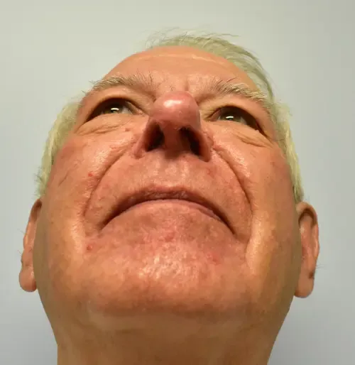 Rhinoplasty patient 2, after