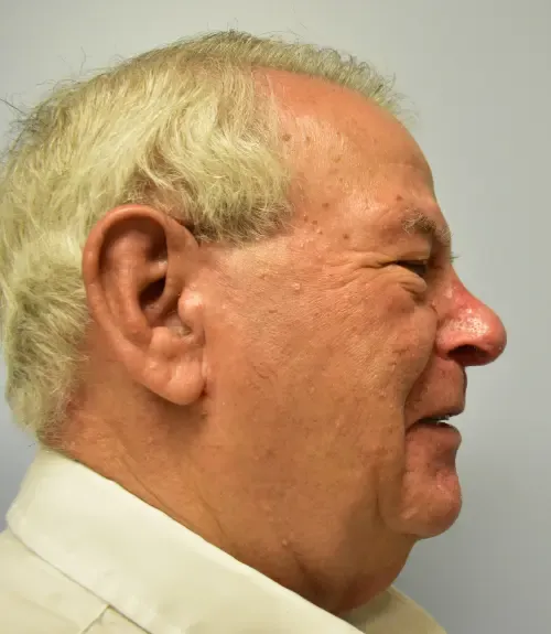 Rhinoplasty patient 3, after