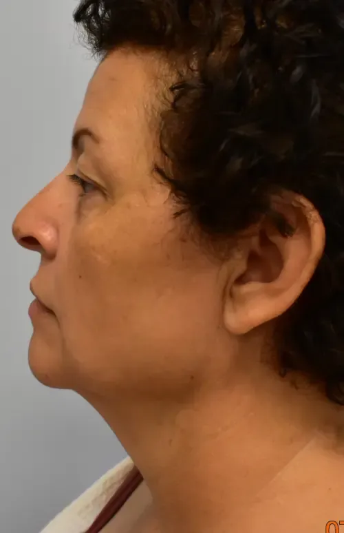 Facelift patient 2, before