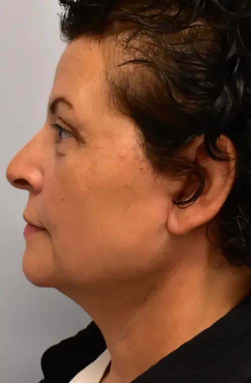 Facelift patient 2, after
