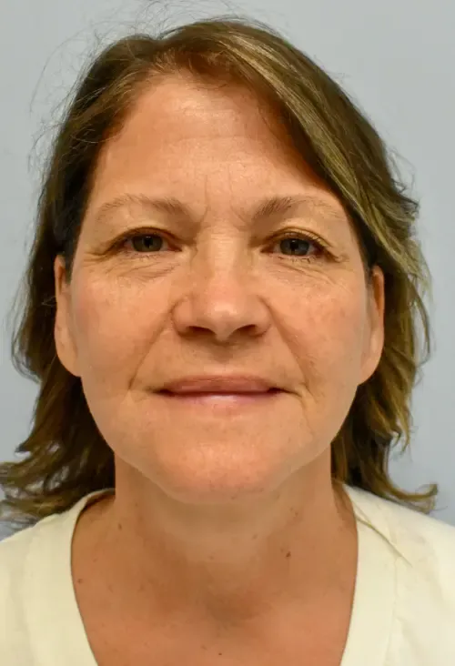 Facelift patient 2, after