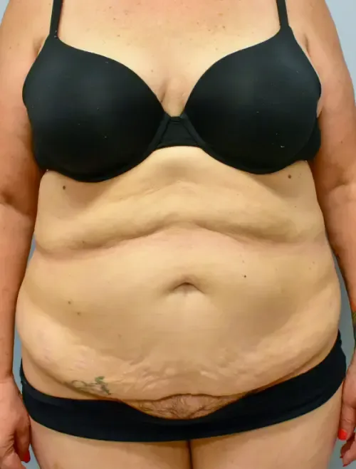 Tummy Tuck patient 7, before