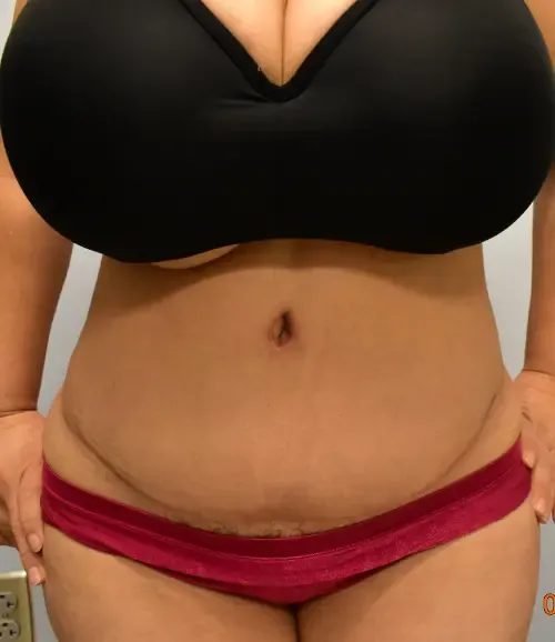 Tummy Tuck patient 9, after