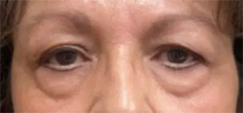 Eyelid Lift (Blepharoplasty) patient 1, before