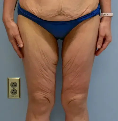 Thigh Lift patient 1, before