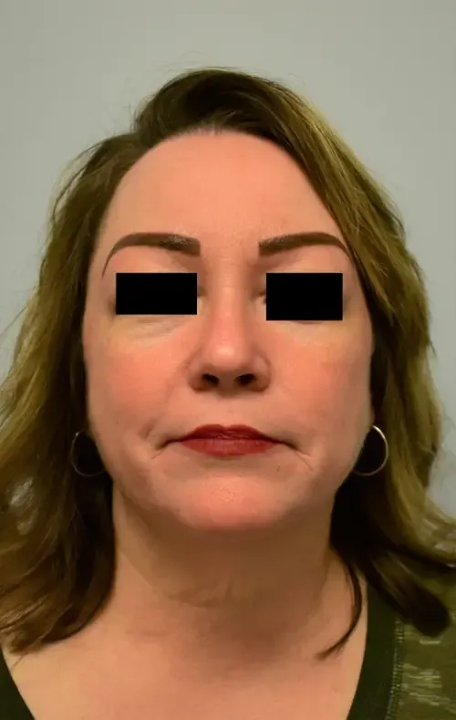 Facelift patient 4, before