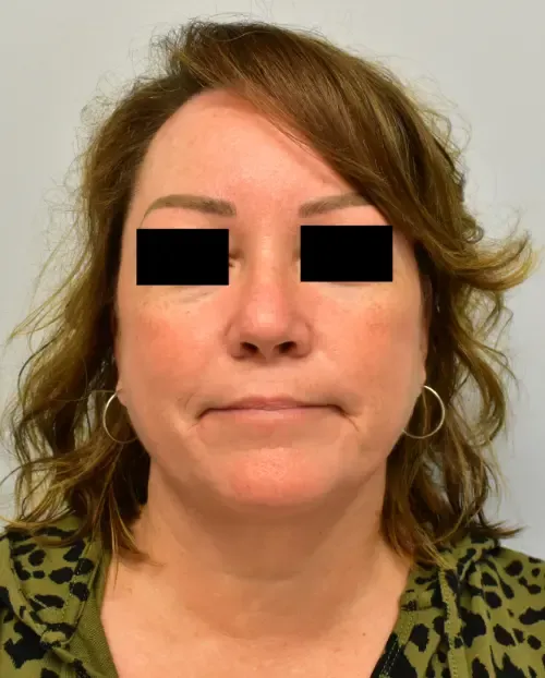 Facelift patient 4, after