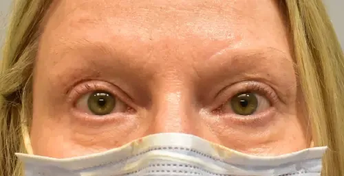 Eyelid Lift (Blepharoplasty) patient 2, after