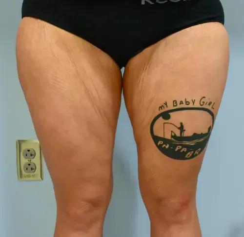 Thigh Lift patient 2, before