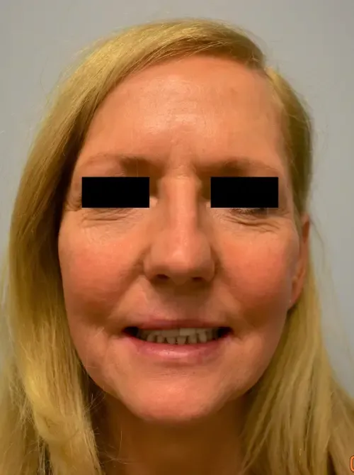 Facelift patient 6, before