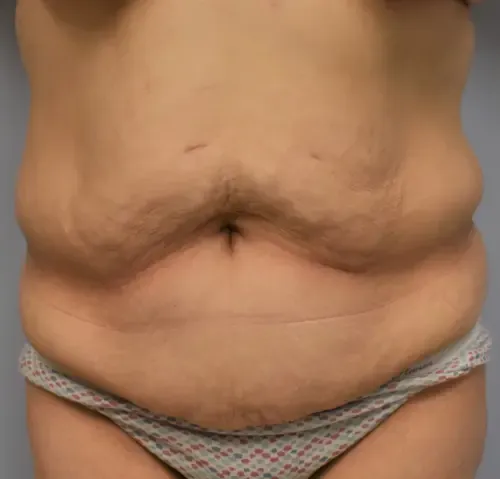 Tummy Tuck patient 10, before