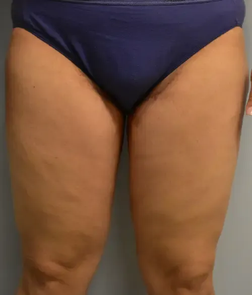 Thigh Lift patient 3, after