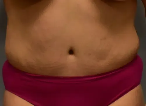 Tummy Tuck patient 10, after
