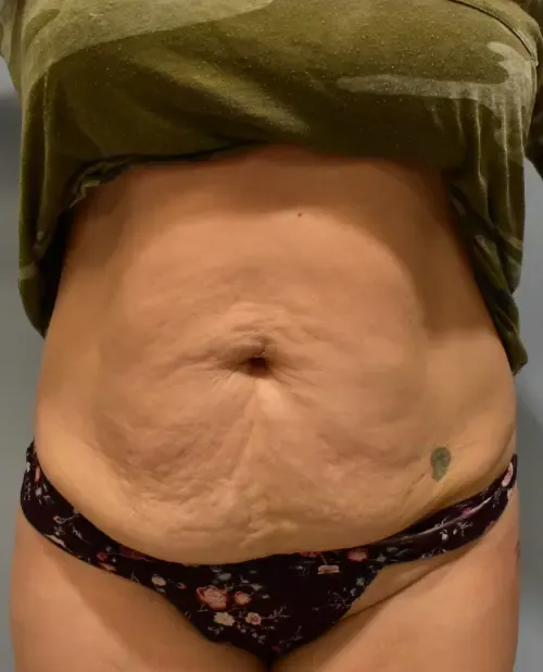 Tummy Tuck patient 11, before